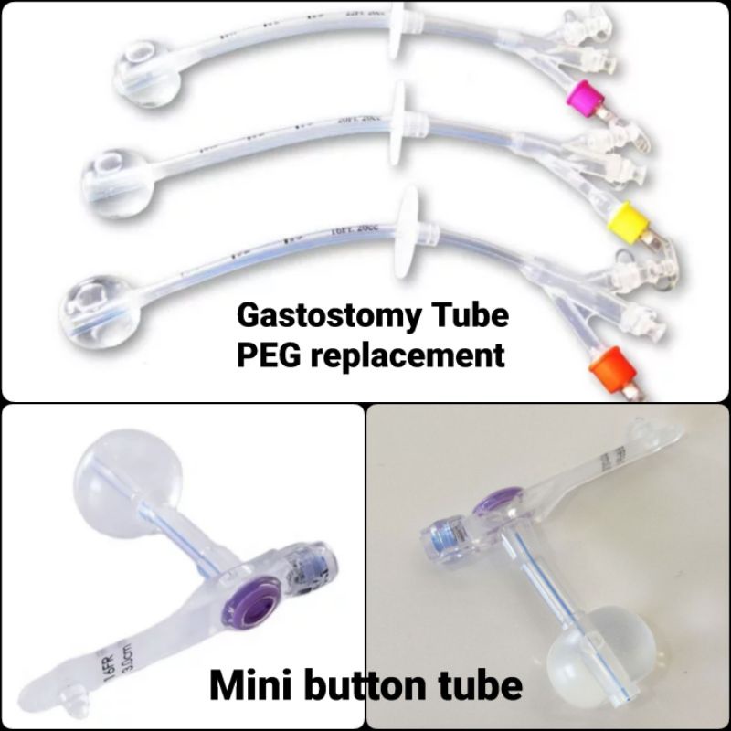 Silicone Gastrostomy Tube Peg Types Gastrostomy Tubes, 51 OFF